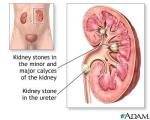 kidney stone
